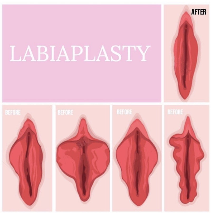 Labiaplasty Graphic